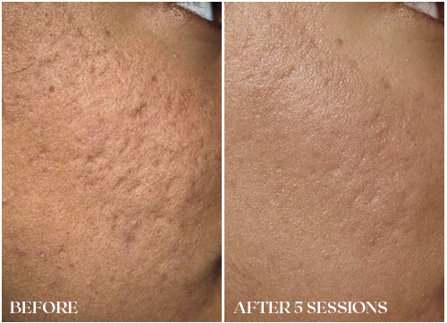 fraxel acne scarring